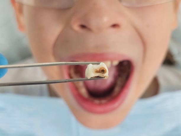 Best Emergency Treatment for Dental Infections or Abscesses in Yorkville, NY